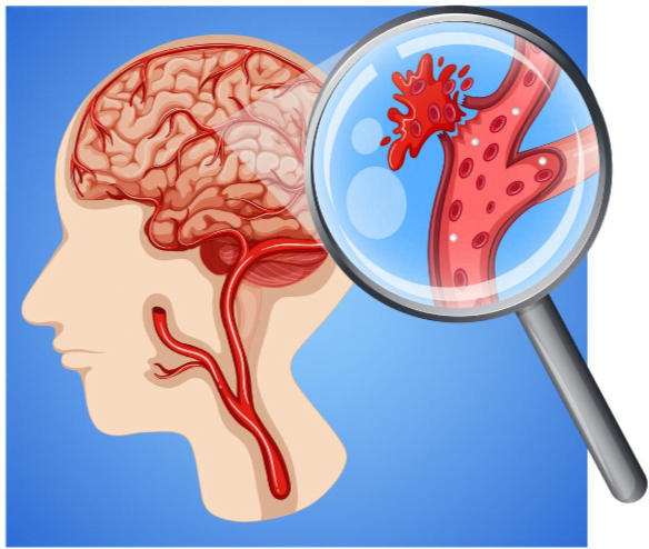 aneurysm-1