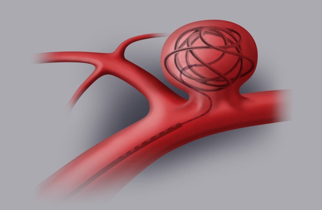 aneurysm-2
