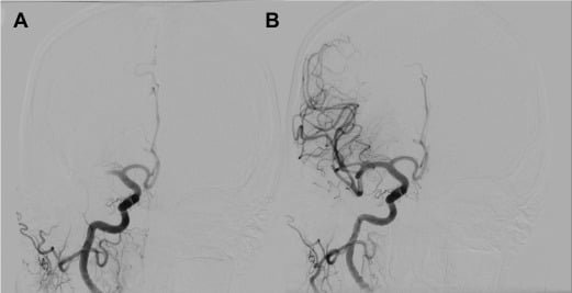 aneurysm-4