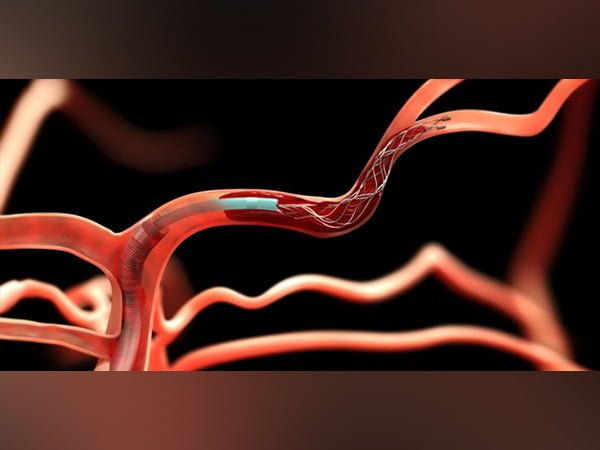 aneurysm-5