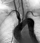 angiography-1
