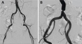 angiograph-2