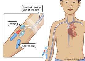 central-venous-catheter-placement