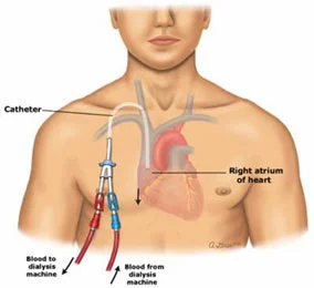central-venous-catheter-placement
