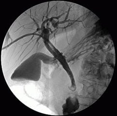 cholangiograph-1