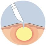 Abscess