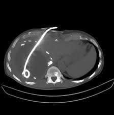 drainage-catheter-placement