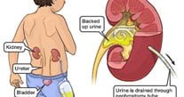percutaneous-nephrostomy
