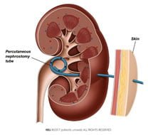 percutaneous-nephrostomy-2