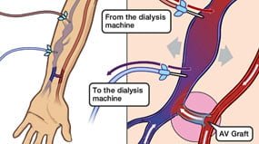 renal-3