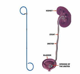 ureteral-stent-exchange