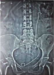 ureteral-stent-exchange-1