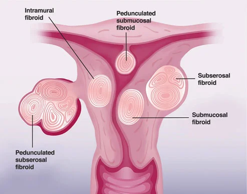 uterine-1