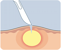 Abscess Treatment - Aspiration, Pigtail Drainage