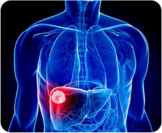 Cancer Treatments– TACE, RFA, Embolization