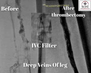 DVT-content