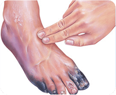 Non-Healing Wound Management