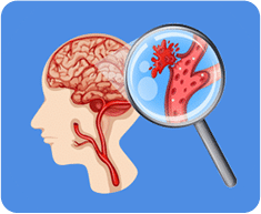 Treatment of Aneurysm and Stroke