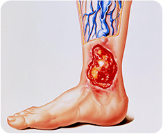 Varicose Veins &  Varicose Ulcer Treatment