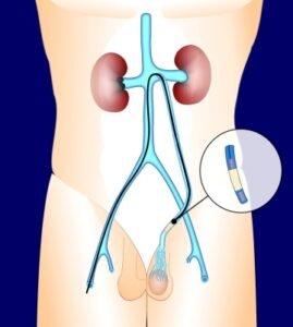 Varicocele-Embolization