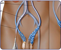 Varicocele Embolization