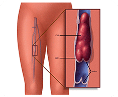 Deep Vein Thrombosis (DVT) Treatment