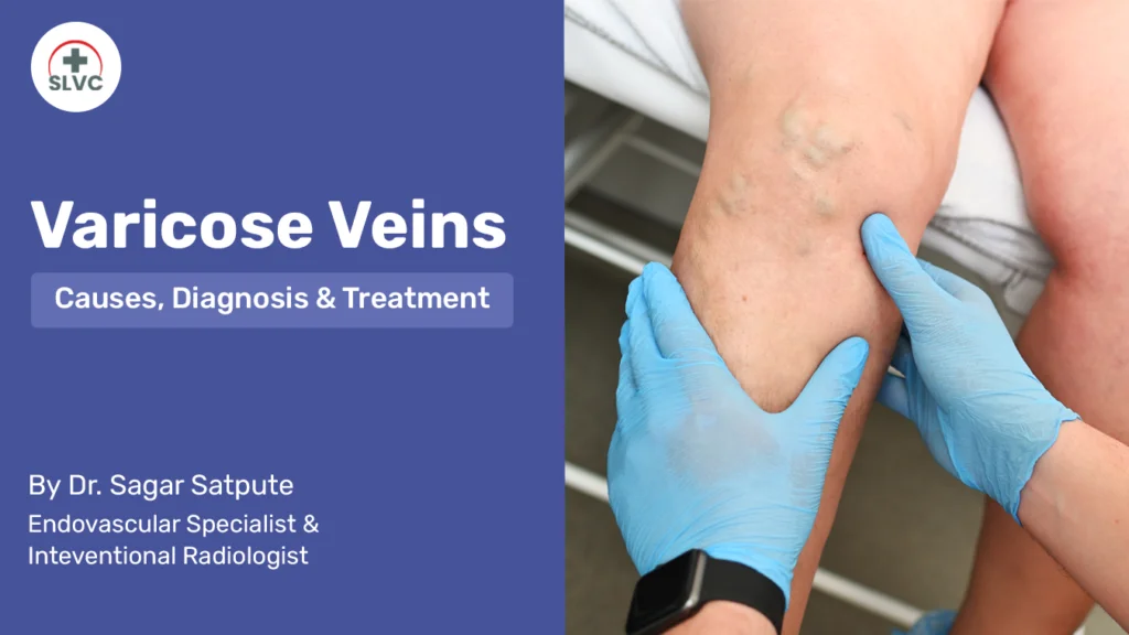 Varicose Veins – Causes, Diagnosis & Treatment