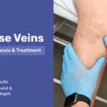 Varicose Veins – Causes, Diagnosis & Treatment2