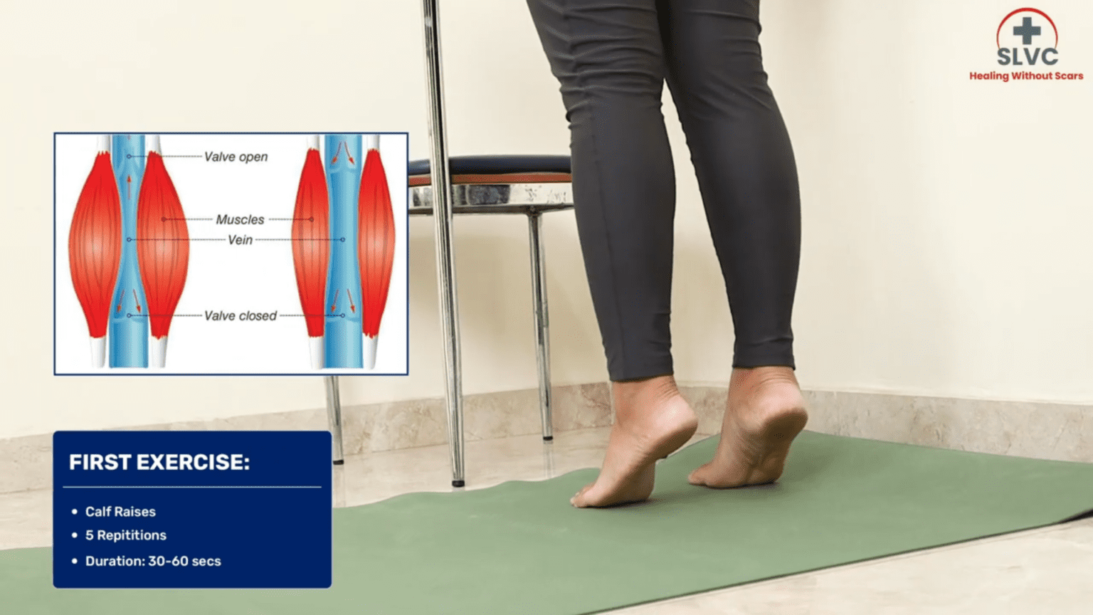 The Importance of Exercise and Yoga in Managing Varicose Veins