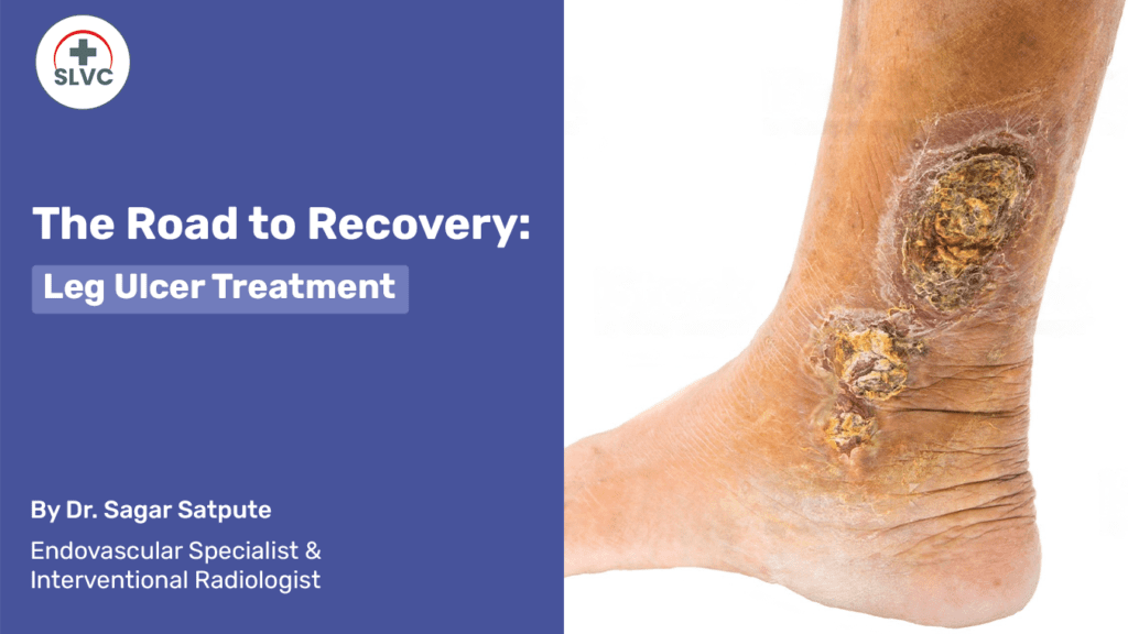 The Road to Recovery: Leg Ulcer Treatment