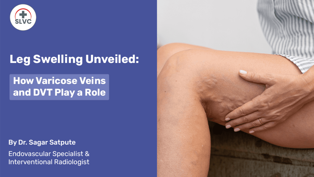Leg Swelling Unveiled: How Varicose Veins and DVT Play a Role2