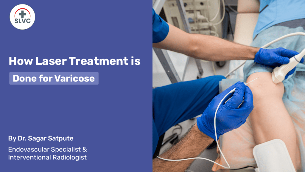 How Laser Treatment is Done for Varicose Veins?