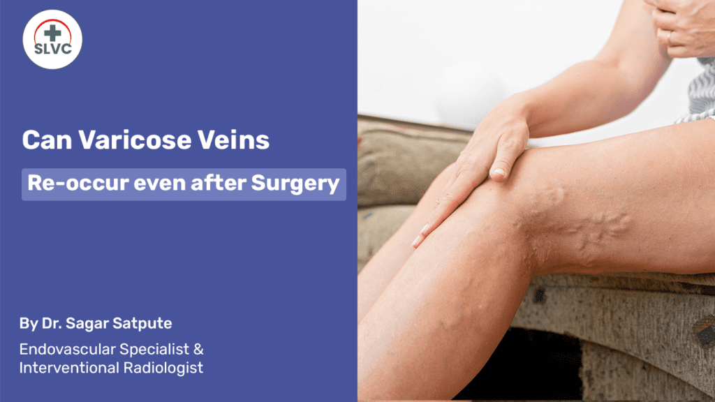 Can Varicose Veins Re-occur even after Surgery