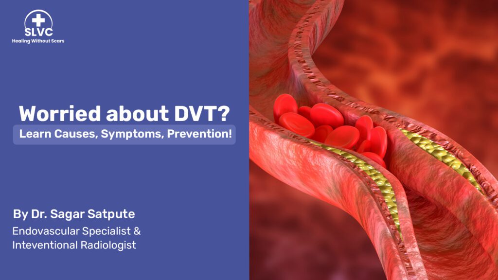Deep Vein Thrombosis (DVT) – How it occurs, Symptoms, Diagnosis, and Treatment2