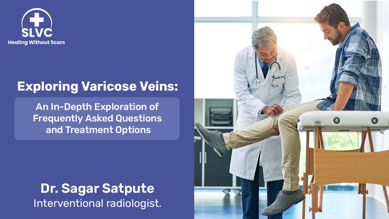 Exploring Varicose Veins An In Depth Exploration Of Frequently Asked Questions And Treatment 